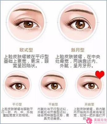 韩式三点双眼皮是怎么做的 韩式双眼皮怎么做